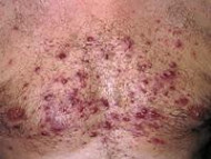 steroid acne s