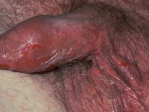 Secondary syphilis