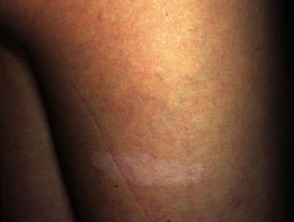 Ash leaf marks in tuberous sclerosis