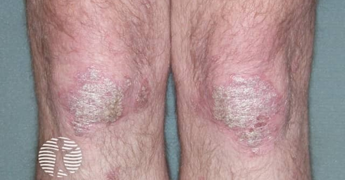 Psoriasis Before Commencing Adalimumab Image