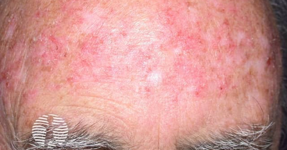 DermNet Imiquimod To Actinic Keratosis Image