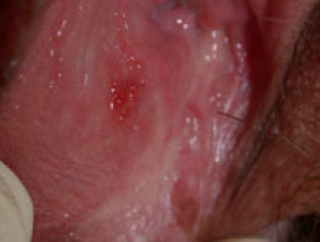 Vulval ulcer