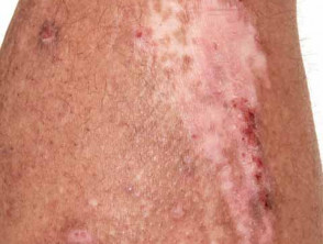 Lichenified atopic dermatitis with post-inflammatory dyspigmentation in adult with skin of colour