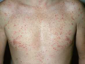 Dermatitis Herpetiformis Images DermNet