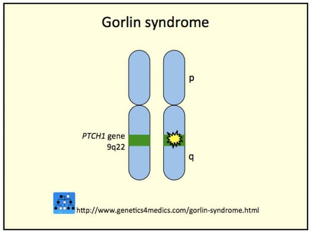 Genetics of Basal cell naevus syndrome (Image courtesy Genetics 4 Medics)