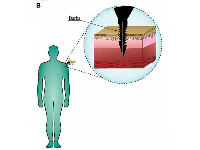 Barbs on the lancet prevent withdrawal from the skin