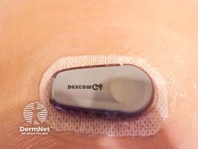 The glucose monitor is in place with  the barrier dressing in situ - none of the original device adhesive makes contact with the skin