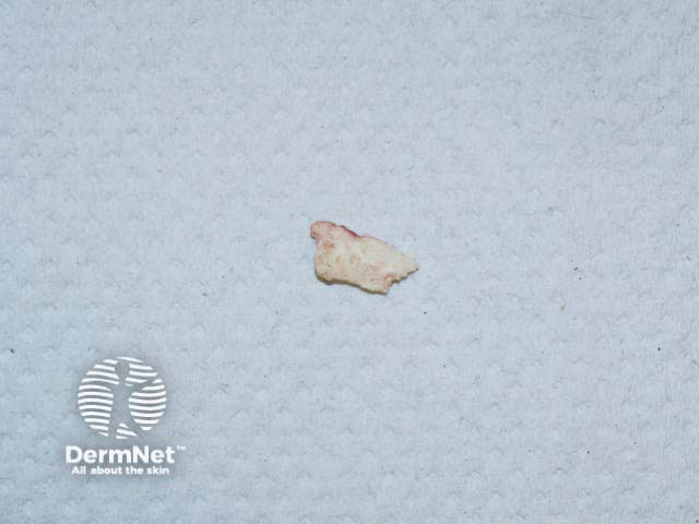 A piece of calcium extruded from an area of calcinosis cutis