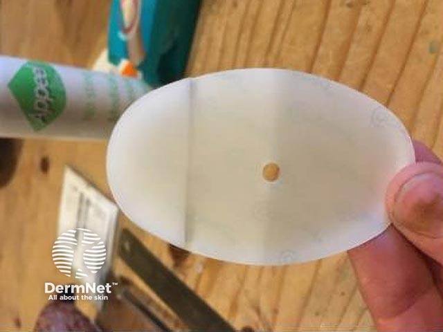 The hole  made by the punch can be clearly seen in the barrier dressing