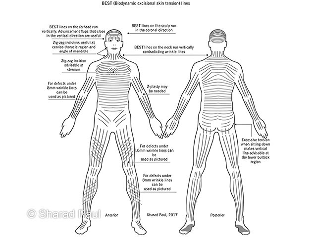 Biodynamic excisional skin tension lines (courtesy of Dr S Paul)