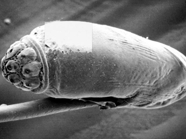 A head louse egg securely attached to the hair shaft.  The cap will detatch when the larva leaves the egg case