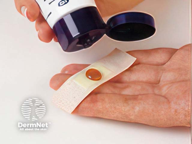 Manuka honey being applied to an adhesive dressing