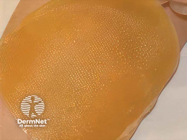 Manuka honey-impregnated wound dressing