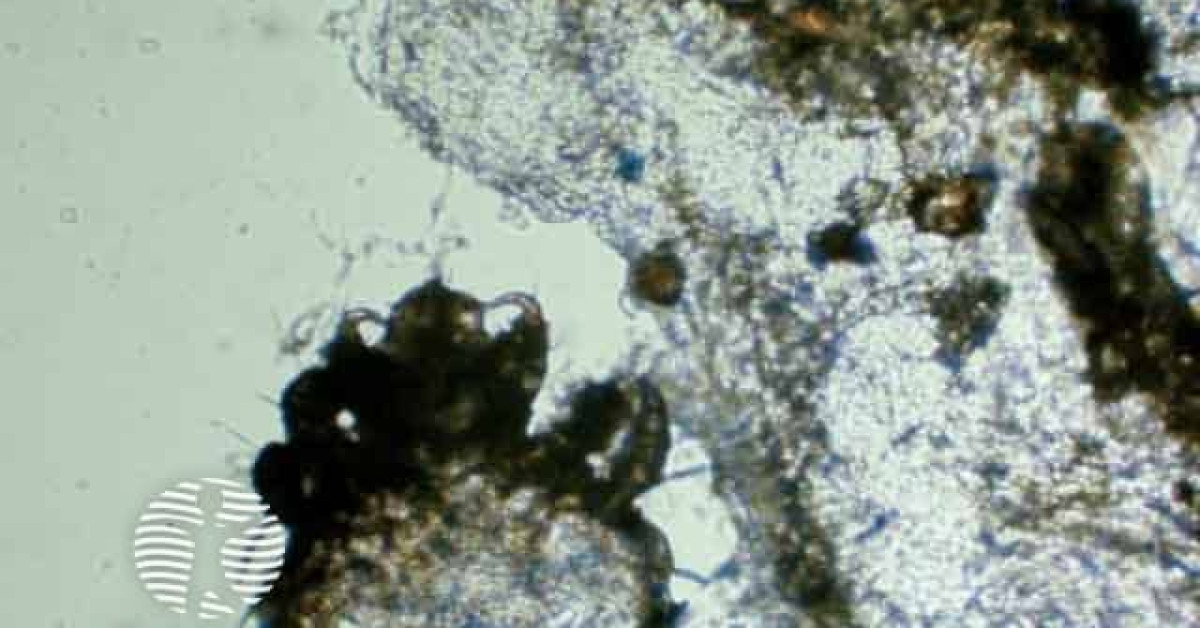 Scabies Micro Video Scabies image