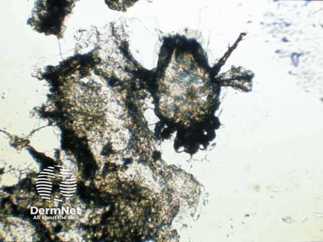 A scabies mite on microscopy after extraction from a burrow