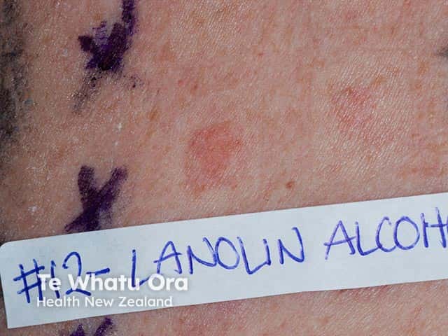Positive patch test to lanolin alcohol