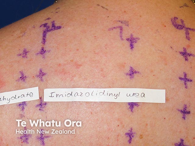 Weak positive imidazolidinyl urea patch test