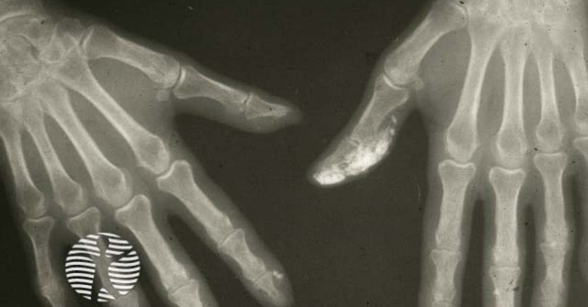 Xray calcium deposits fingers image
