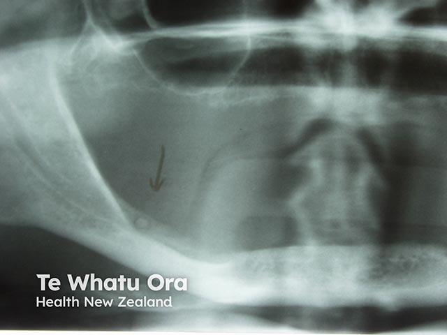 A retained root that was the cause of a dental sinus 