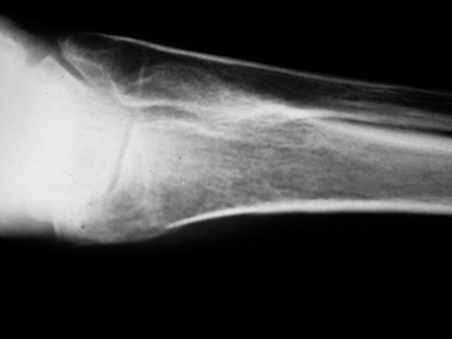 New bone formation on the ulna due to pachydermoperiostosis