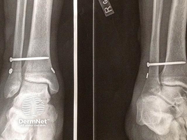 Ankle fracture with surgical fixation underlying post-traumatic skin blisters