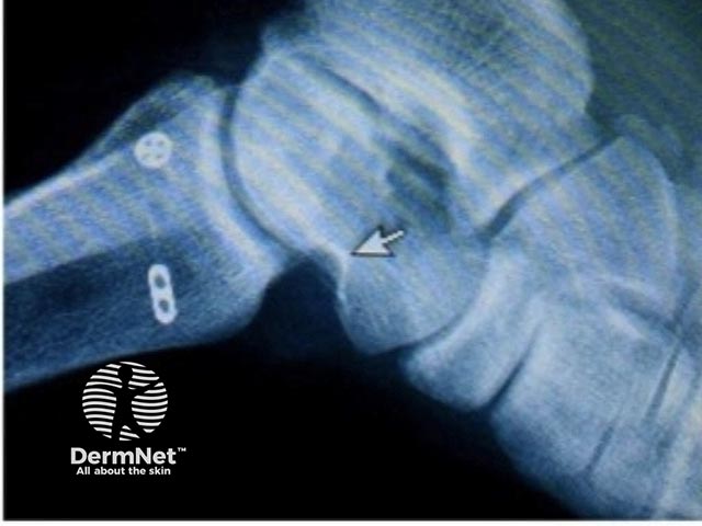 Ankle fracture post-surgery - the fracture resulted in post-traumatic blisters