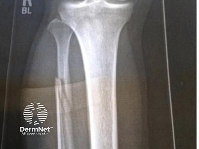 A fibular fracture with an associated ankle fracture that resulted in post-traumatic skin blisters