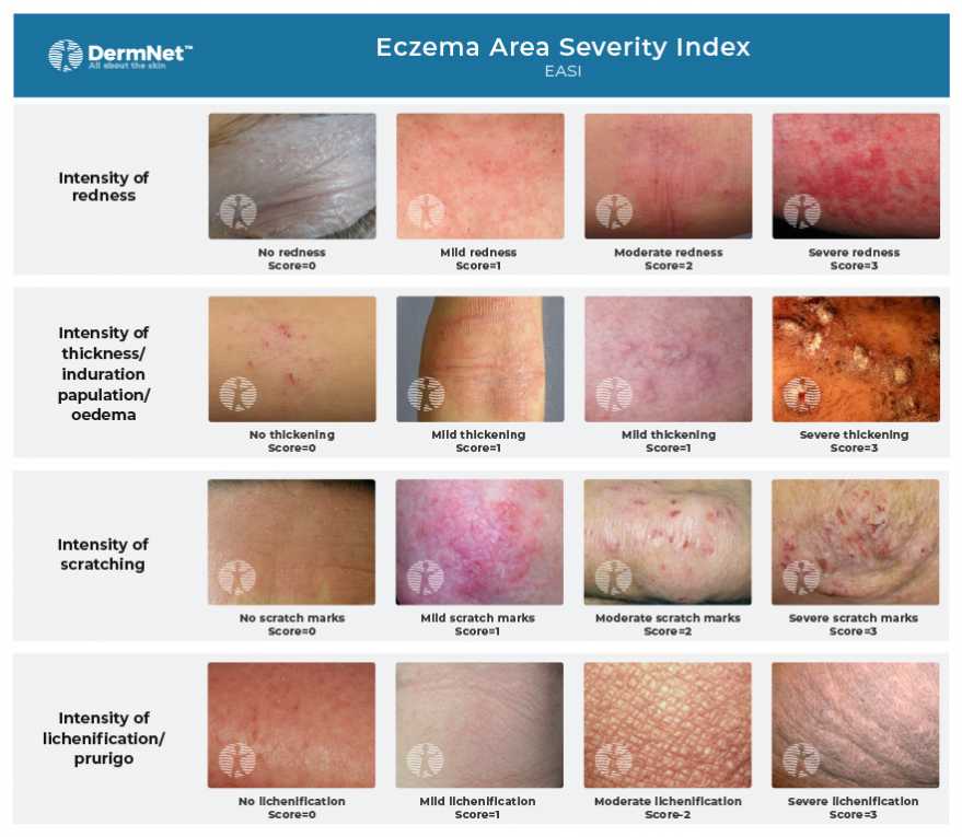 EASI score. Eczema area and severity index | DermNet