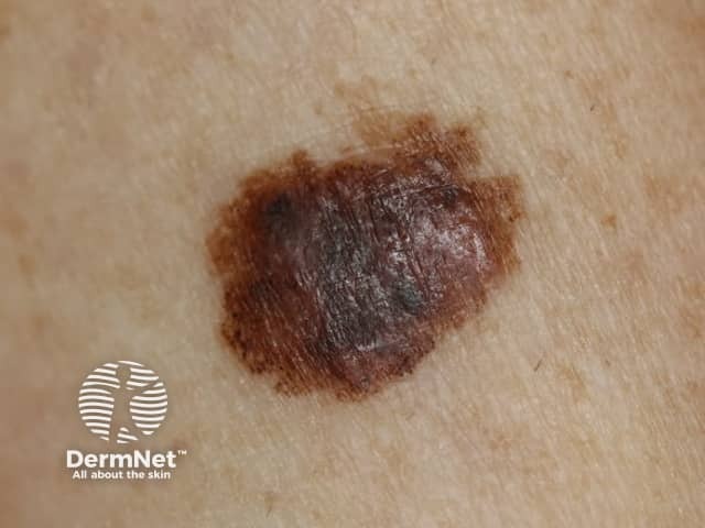 Large melanoma in situ