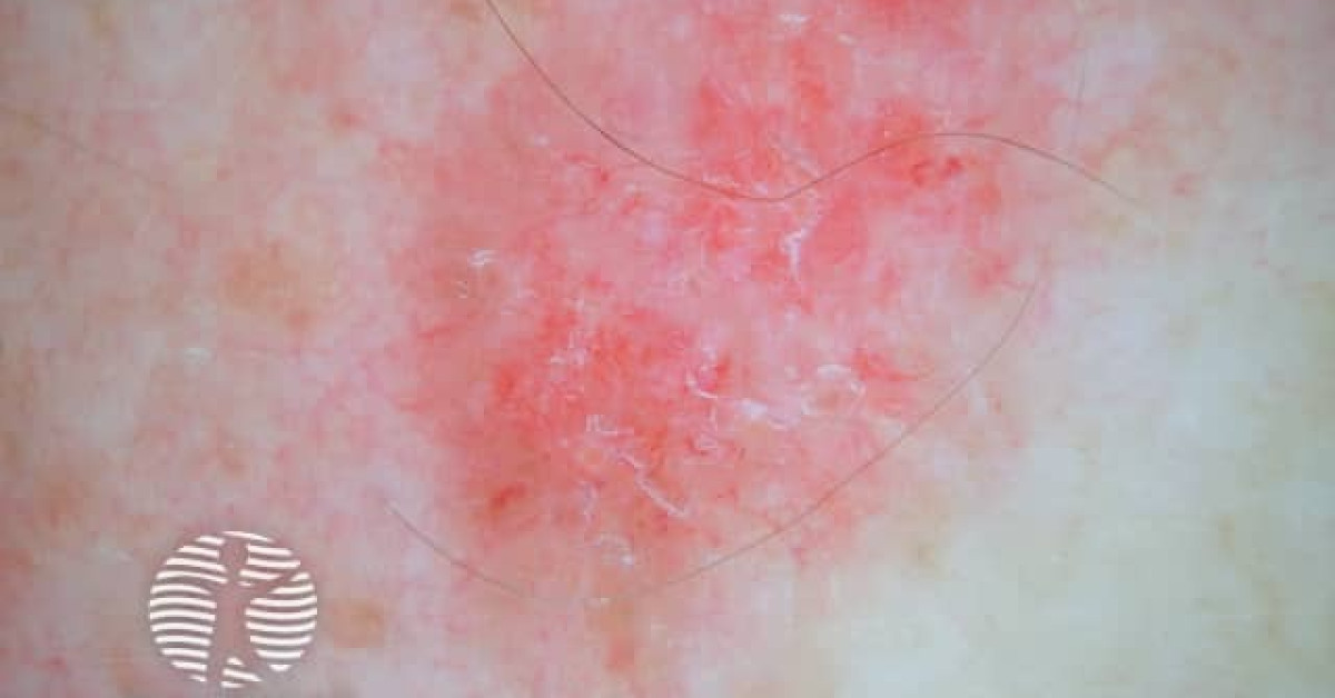 Superficial basal cell carcinoma dermoscopy image