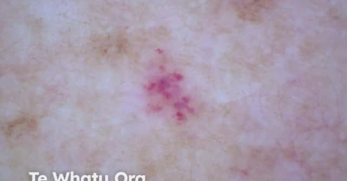 Cherry angioma dermoscopy image