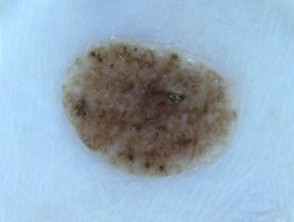Naevus, skin type 2, dermoscopy 2