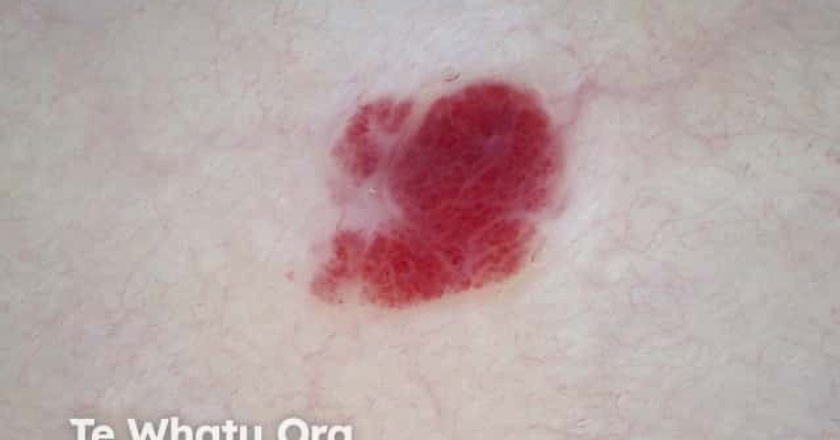 Cherry angioma dermoscopy image