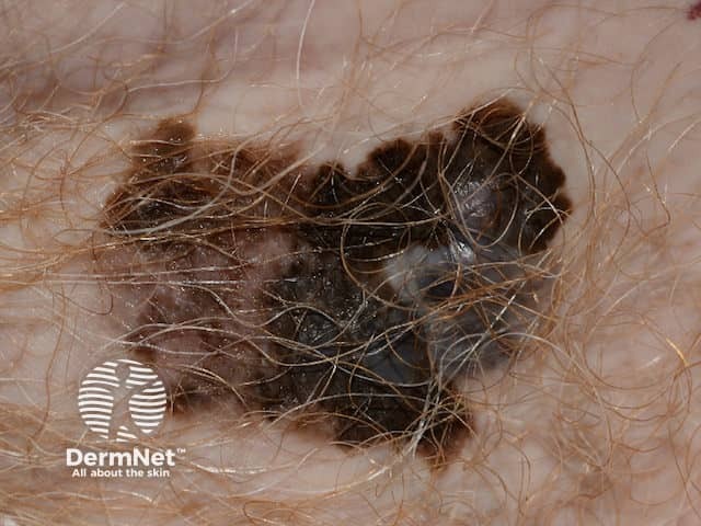 A superficial malignant melanoma - irregular and notched margin, variable and irregular pigmentation in an itchy and enlarging pigmented lesion