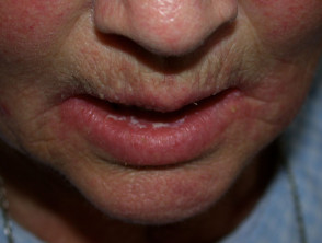 Candida Albicans Lips