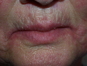 Candida affecting the lips, mouth and face images | DermNet