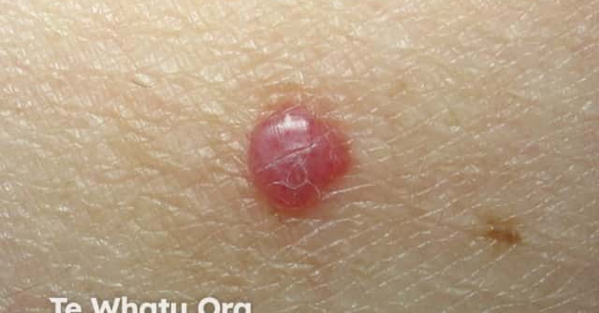 Cherry angioma image