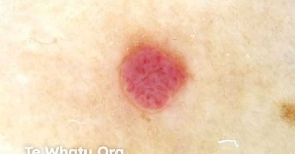 Cherry angioma dermoscopy image