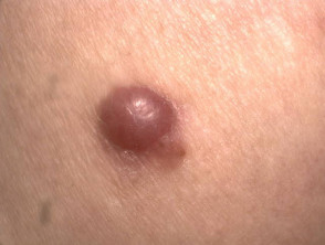 Amelanotic nodular melanoma