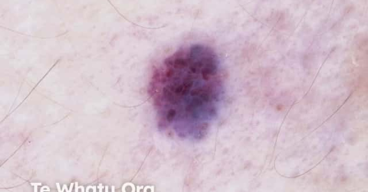 Cherry angioma dermoscopy image
