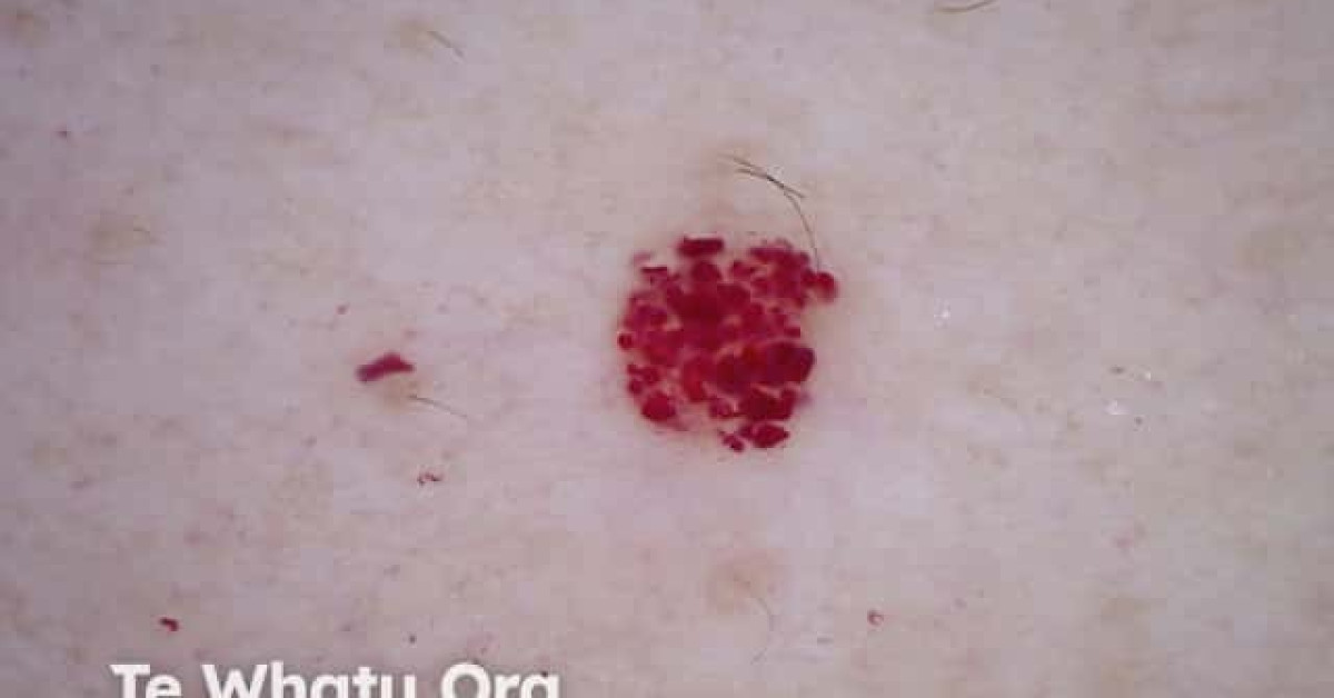 Cherry angioma dermoscopy image