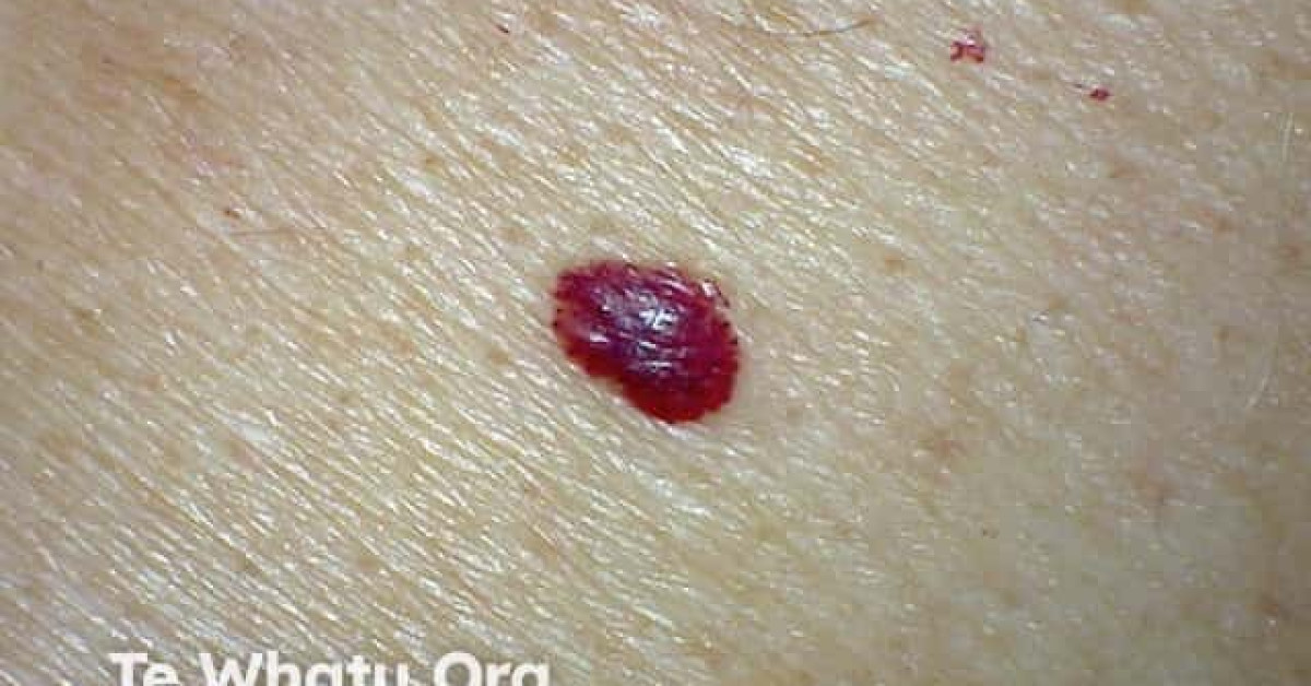 DermNet® - Cherry angioma image