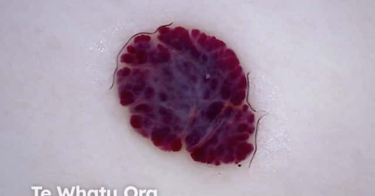 Cherry angioma dermoscopy image