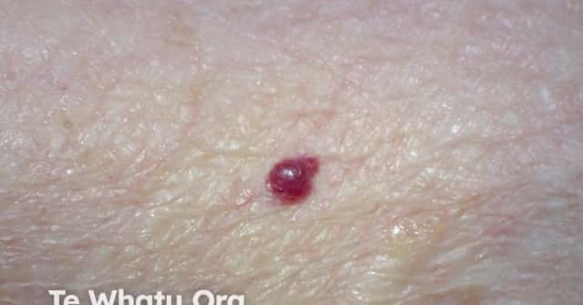 Cherry angioma image