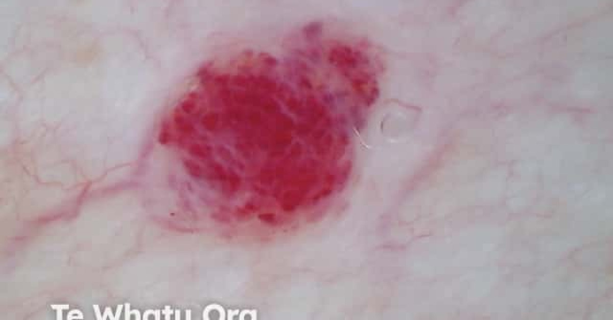 Cherry angioma dermoscopy image