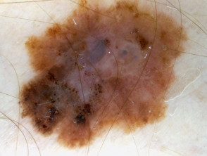 Dermoscopy: melanoma with streaks