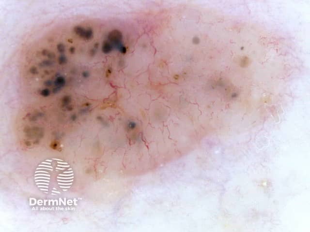 Branching serpentine vessels and blue-grey ovoid nests in pigmented basal cell carcinoma dermoscopy