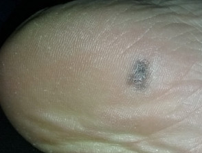 Acral lentiginous melanoma 0.95 mm