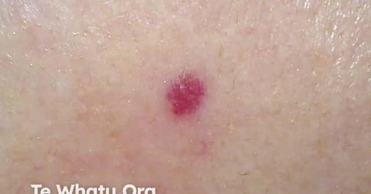 Cherry angioma image