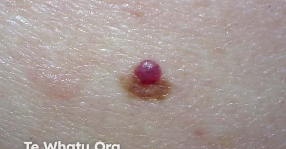 DermNet® - Cherry angioma image